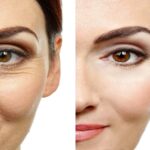 WRINKLES AROUND THE EYES