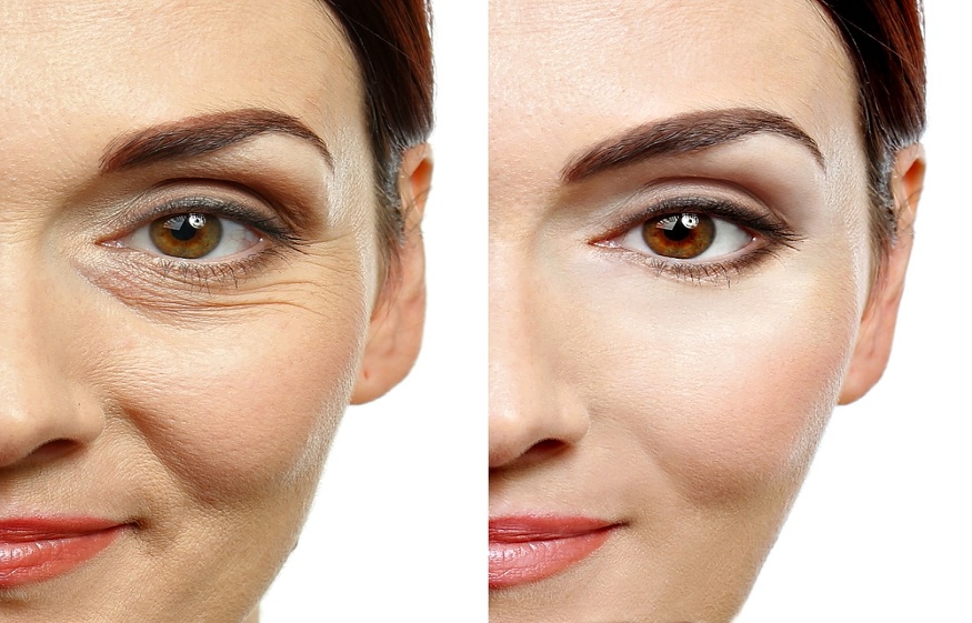 CROW’S FEET: HERE ARE 8 TARGETED TREATMENTS TO PREVENT THE APPEARANCE OF WRINKLES AROUND THE EYES
